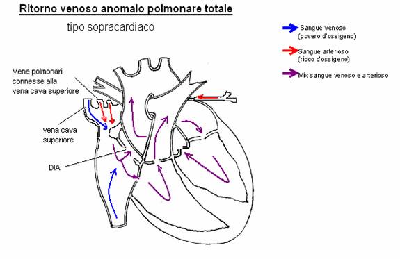 Isolamento bilaterale della vena polmonare