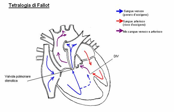 Tetralogia di Fallot